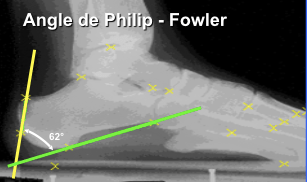 Angle de Philip-Fowler