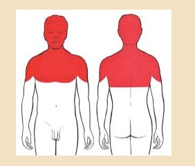 Douleurs projetées cervicale