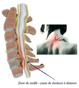 douleurs projetées cervicales