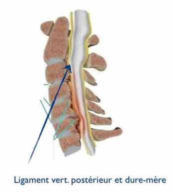 Ligament vert post +dure-mère