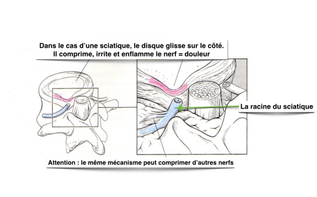 Lassague Lombalgies-sciatique « ORTHOPEDIE POUR TOUS