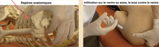 Epaule infilt capsule