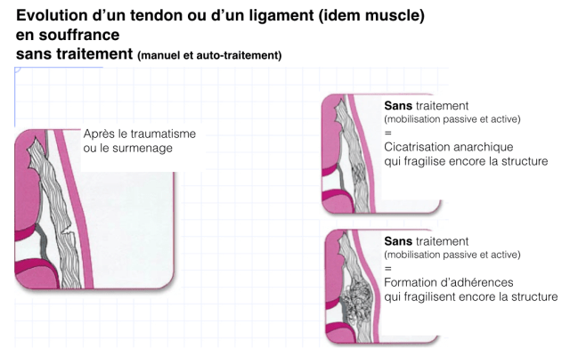 formations d'adhérences