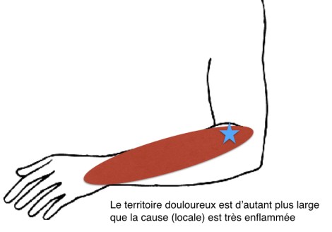Epicondylite douleur projetée